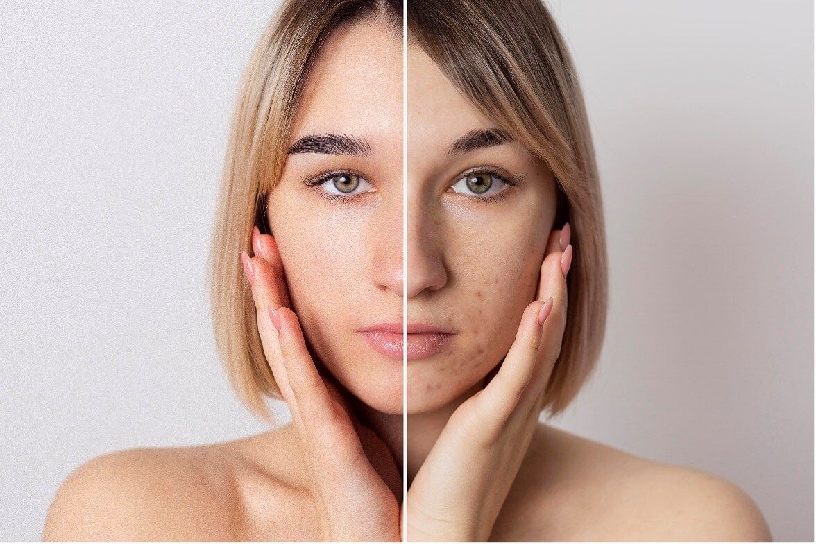 Jak pozbyć się trądziku