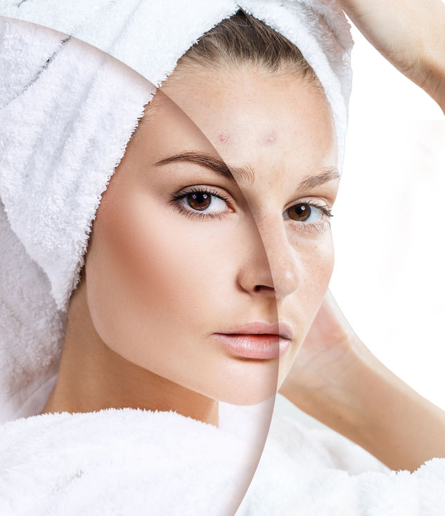 Rozjaśnianie przebarwień