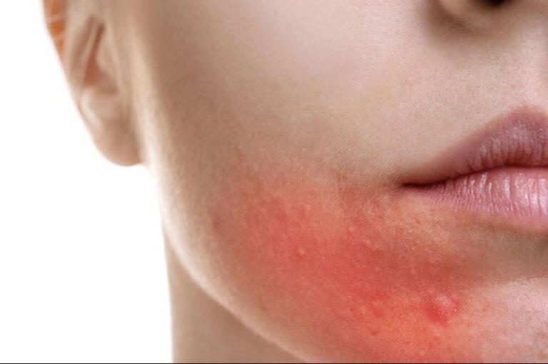 Trądzik różowaty </br> cera naczynkowa