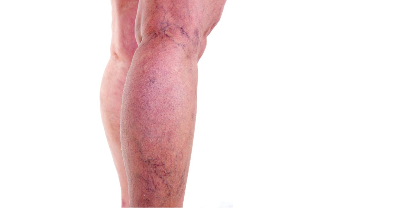Żylaki a masaż i fizjoterapia