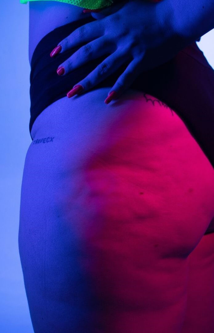 Zdjęcie z cellulitem na udach