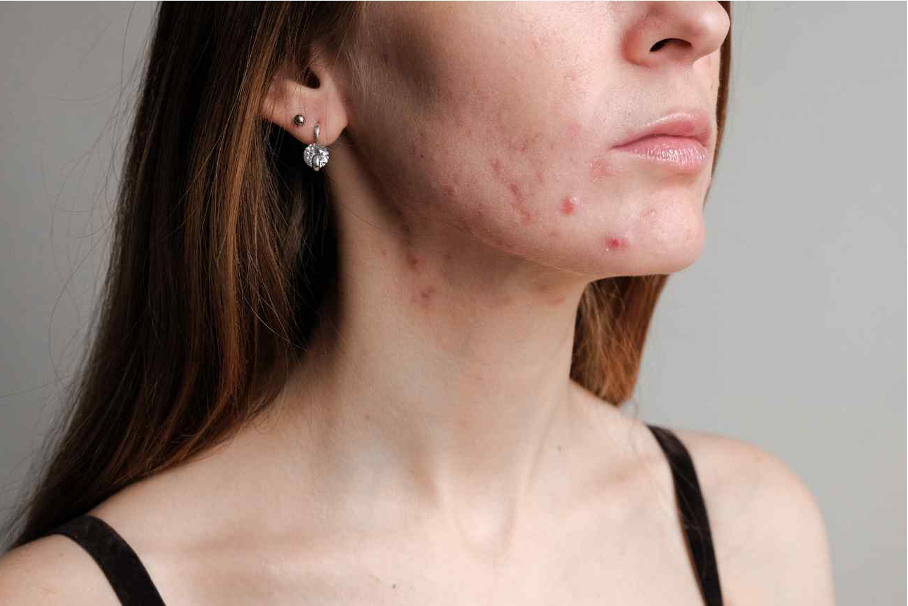 rądzik leczenie w Holispace