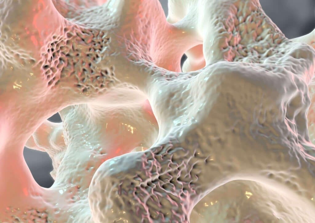 Osteoporoza cichy wróg kości. Ortopedia w Holisppace