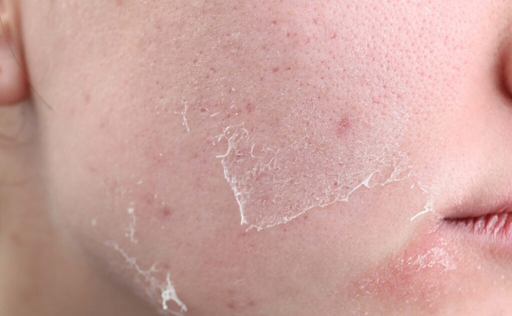 Odmładzanie okolic oka - Retix C Eye